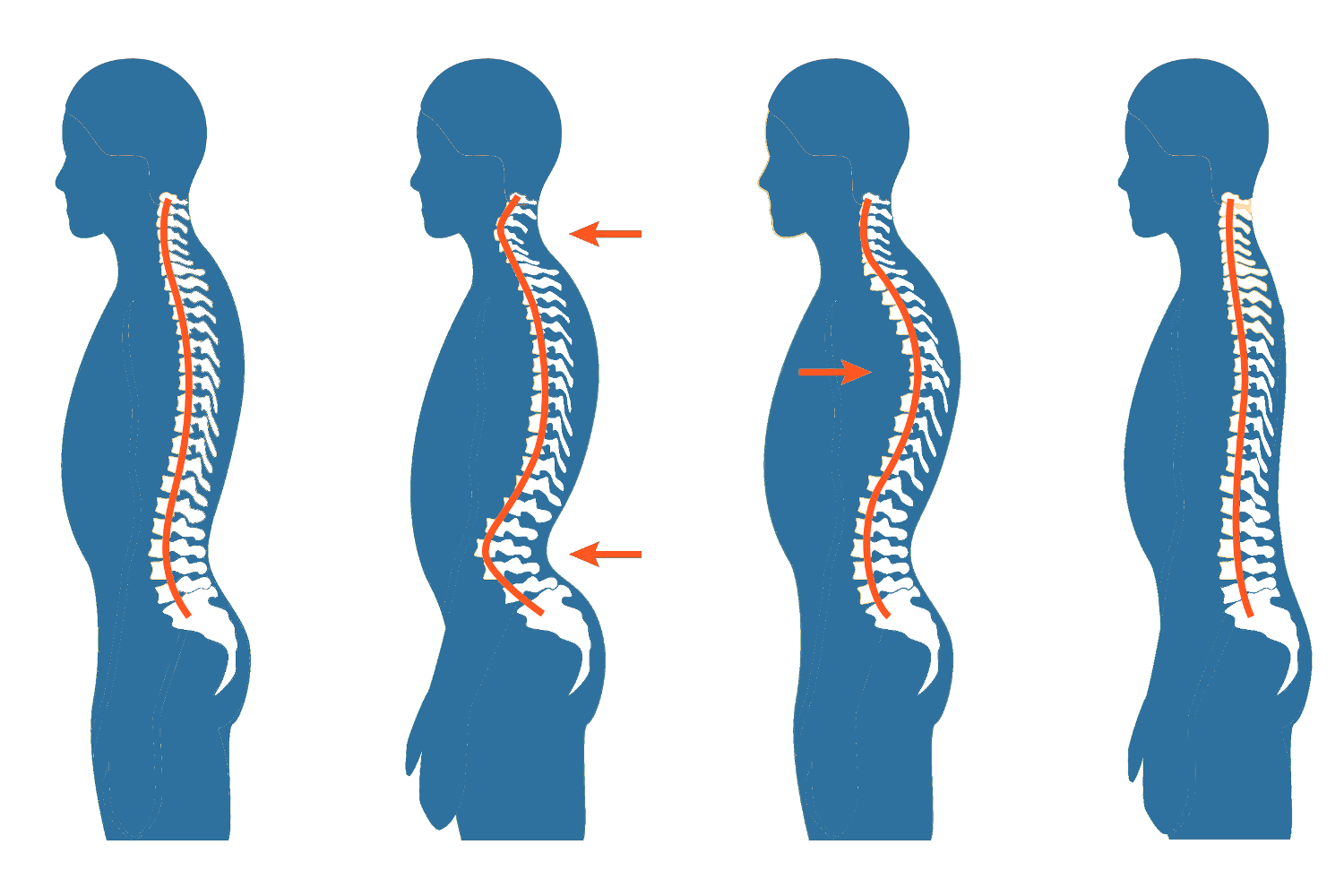 Lateral view of different posture types