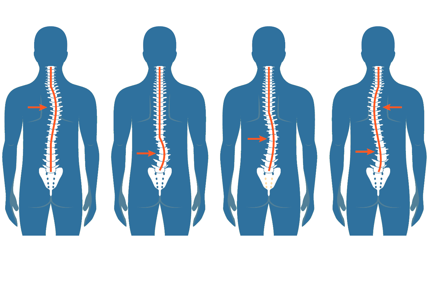 Posterior view of types of scoliosis